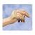Radial Nerve Splint