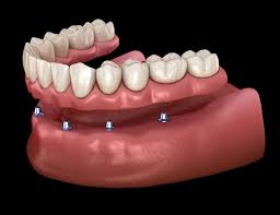 8 complete set of dentures (upper or lower jaw): Can I Replace All My Teeth Yes A Dentist Explains Two Different Options