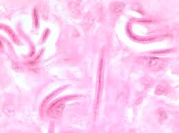 Image result for skin biopsy onchocerca