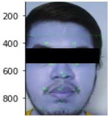 Amyotrophic Lateral Sclerosis and Post-Stroke Orofacial Impairment  Video-based Multi-class Classification
