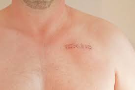 Valve replacement (mechanical versus biological), congenital heart surgery, lima cabg, aa/ad repair, heart transplant. 1 447 Pacemaker Photos Free Royalty Free Stock Photos From Dreamstime