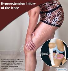 The knee can easily be stretched or twisted in a way there are immediate signs that you might have hyperextended your knee, and symptoms that. What Is Hyperextension Injury Of The Knee How Is It Treated