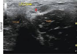 We did not find results for: Lateral Femoral Cutaneous Nerve Block Anesthesia Key