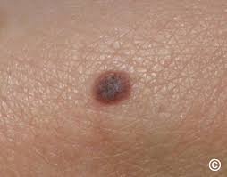 Image result for Spitz Nevus