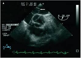 Photoclinic Platypnea Orthodeoxia Syndrome Consultant360
