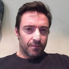Learn more about targeted therapy, surgery, and chemotherapy. Hugh Jackman Gets Skin Cancer Removed From Nose How Does Basal Cell Carcinoma Develop Video