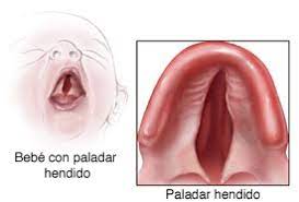 Esta malformación genera una comunicación anormal entre cavidad oral y. Informacion Sobre El Labio Hendido Y El Paladar Hendido Cdc