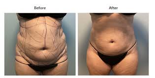 Image result for Liposuction