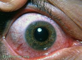 Image result for Eye Foreign Body