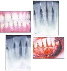 Lateral Periodontal Cyst A Clinical Photograph Showing Mild Gingivitis Download Scientific Diagram