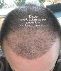 · puoi lavarti i capelli dopo 3 giorni dall' intervento. I Trapianto Capelli Fue Istanbul Fix Hair Istanbul Facebook