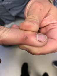 If you spend a lot of time staring straight ahead while stuck in traffic, you may have wondered what those tiny black dots circling the edges of your car's windshield are. Painless Nodules On The Fingers Clinical Advisor
