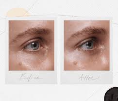 How long does a classaction lawsuit last? Everything You Need To Know About Under Eye Fillers
