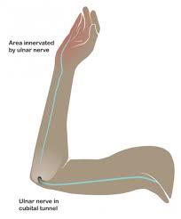 Cubital Tunnel Syndrome Philip A Griffin