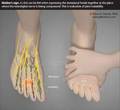Morton S Neuroma Injections Caring Medical Florida