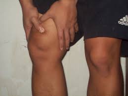 Pembengkakan di kaki paling umum bisa terjadi karena pengaruh penumpukan cairan dalam tubuh. Sakit Lutut Asam Urat Atau Rematik Atau Apa Kompasiana Com