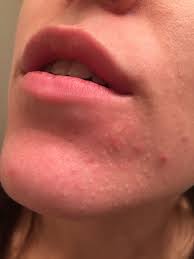 The follicle is completely blocked. Acne Closed Comedone Issues For Years Any Suggestions Comedone Acne Skin Care