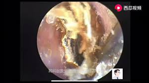 What's more satisfying than the destruction of revolting substances if you're a fan of acne/blackhead removal or other body cleansing videos, you must check out these ear wax removal videos. Ear Wax Removal Extraction A Normal Video Update 2019 06 03 Youtube