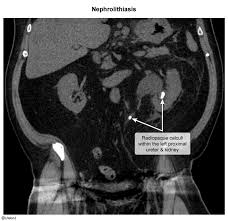 Image result for Nephrolithiasis Imaging