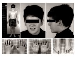Prader Willi Syndrome Biochemistry Medbullets Step 1