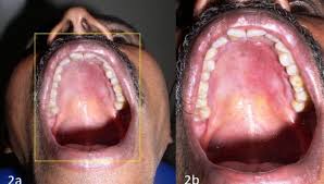 Image result for Oral herpes roof of mouth