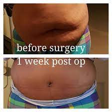 6 Week Journal Of My Tummy Tuck Tummy Tucks Abdominoplasty Tummy Tuck Procedure