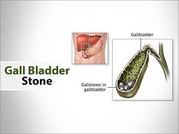 Gallstones Causes Symptoms And Treatments Amrita Homeopathy