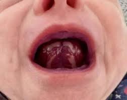 Image result for Puchýře na jazyku