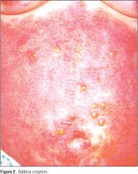 Image result for Vulvitis