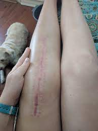 Faster and less painful rehabilitation. Swollen Knee After Knee Replacement Surgery Album On Imgur