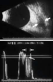 The monthly myositis patient video support session is tailored to those diagnosed with, or suspected of having, polymyositis, dermatomyositis, necrotizing autoimmune myopathy, juvenile myositis, and other unspecified or nonspecific idiopathic inflammatory myopathies (myositis). Orbital Disease In Neuro Ophthalmology Sciencedirect