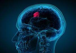 Cells from benign tumors rarely. What Are The Actual Warning Signs Of A Brain Tumor Health Essentials From Cleveland Clinic