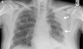 Plain radiograph · pleural opacity which may extend around and encase the lung · reduced volume of the affected hemithorax, resulting in . Unilateral Hyperhidrosis In Malignant Mesothelioma The American Journal Of The Medical Sciences