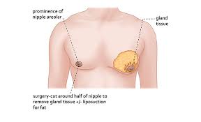 Image result for Gynecomastia