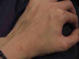 Tie something around your arm. Hand And Arm Veins When Should You Be Concerned