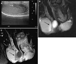 Apr 26, 2016 · tubular ectasia of the rete testis (tert) is a dilatation of the seminiferous tubules of the mediastinum testis. Figure 3 Magnetic Resonance Imaging Of The Scrotum Pictorial Review With Ultrasound Correlation Springerlink