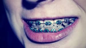However, do it yourself braces is not one of them. 10 Facts About Braces That Ll Leave A Smile On Your Face Bro News