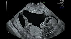 Image result for Ultrasound