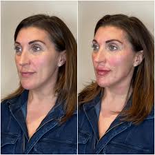 Maryellen Bishop, PA-C, Atlanta Injector, Filler & Botox Expert