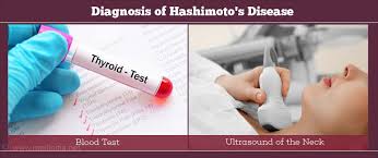 Maybe you would like to learn more about one of these? Hashimoto S Thyroiditis Risk Factors Types Causes Symptoms Diagnosis Treatment Complications