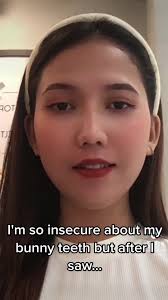 Insecurity Over Bunny Teeth: Overcoming the Struggle