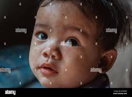 Heat rash hi-res stock photography and images