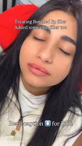 Transform Your Look: Touch Up Lip Filler and Chin Filler Experience