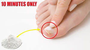 Baking soda for toenail fungus. Toenail Fungus How To Treat Toenail Fungus Fast At Home With Baking Soda Youtube