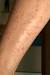 Post Laser Hair Removal Burn