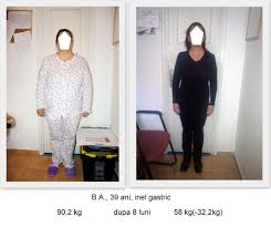 Denumită si operație micșorare stomac, aceasta este o intervenție chirurgicală restrictivă, care se realizează pe cale laparoscopică. Operatie Micsorare Stomac Pret 2019