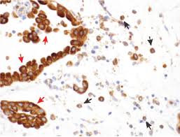Check spelling or type a new query. Https Cancerdiscovery Aacrjournals Org Content Candisc Early 2018 11 26 2159 8290 Cd 18 0804 Full Pdf