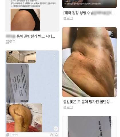 닥터김이 직접 경험한 골반필러 부작용 사례 -태국원정성형 / 골반필러재시술 (혐짤주의) : 네이버 블로그