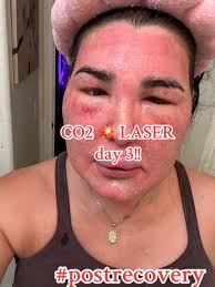 Swelling After Laser