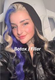 Botox Lip Fillers Journey: My First Experience